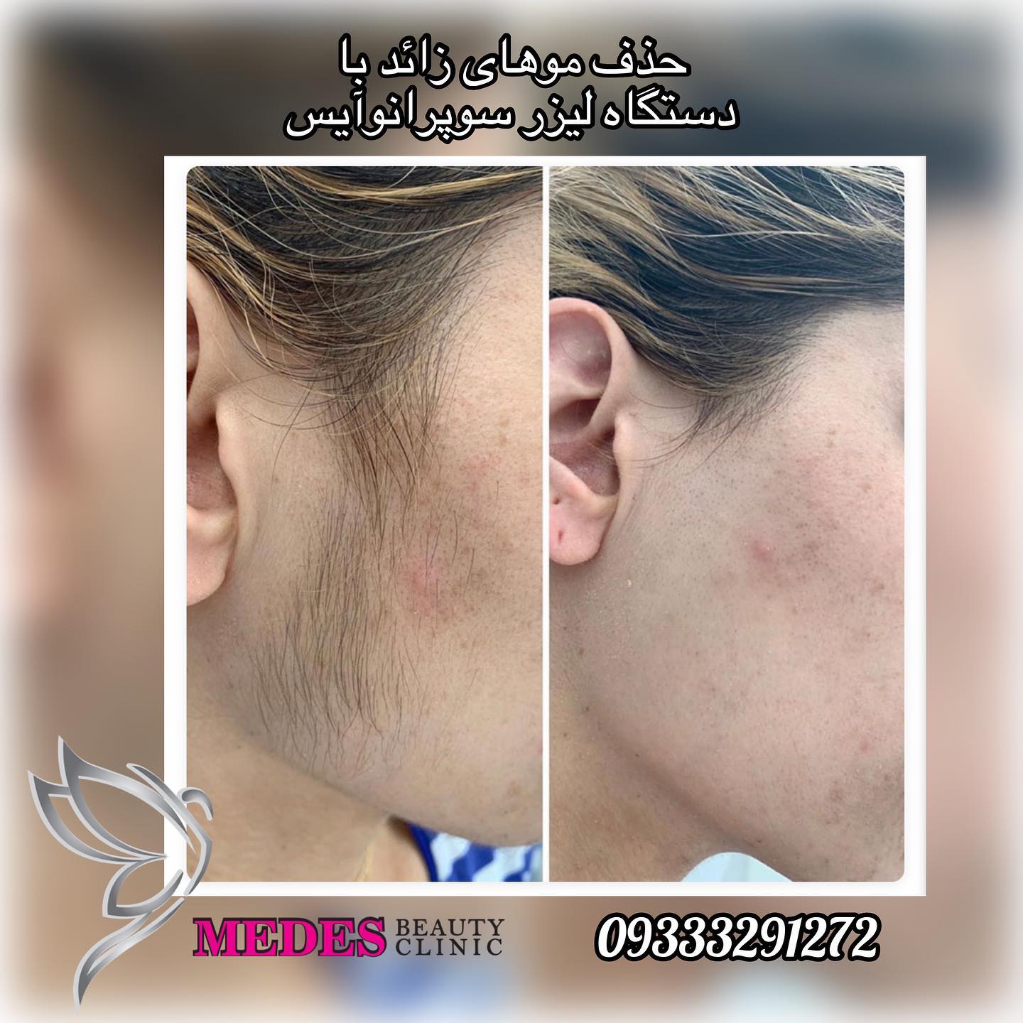 گالری لیزر مو زائد